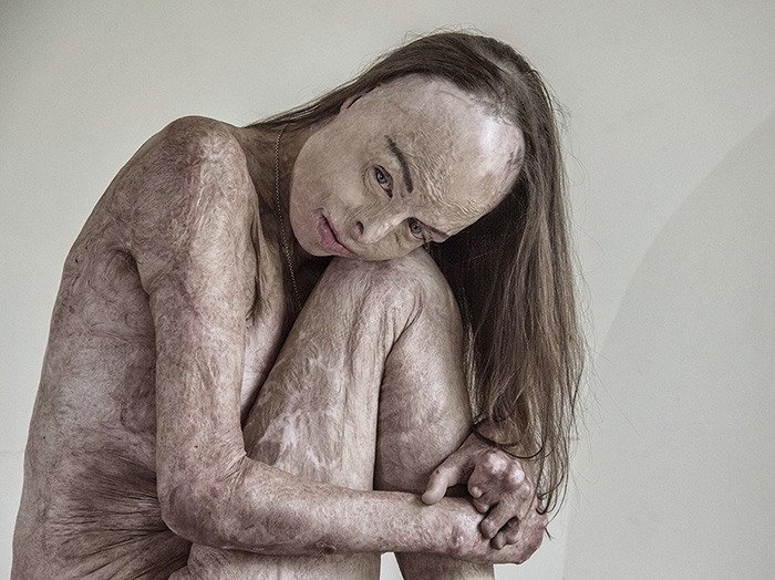 "The Skin I'm In" - Carol Mayer Moscow International Foto ASwards - winner by Brian Cassey