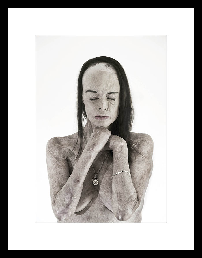 The 2017 National Photographic Portrait Prize: - Canberra - "The Skin I'm In II) - Carol Meyer - by Brian Cassey