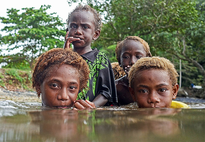 Science Magazine - Best Science Photos of 2018 - PNG children and Yaws disease - image by Brian Cassey