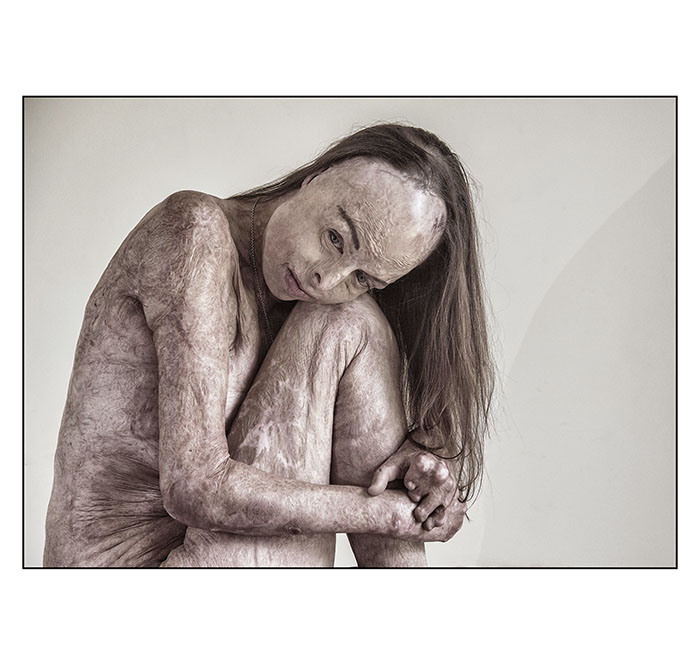 Portrait of Humanity - 'The Skin I'm In' - shortlisted - by Brian Cassey